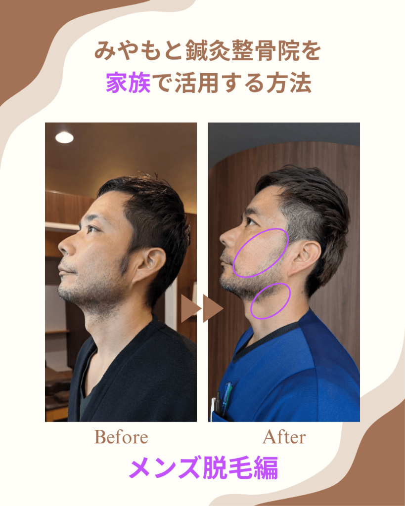 メンズセルフヒゲ脱毛のビフォーアフター