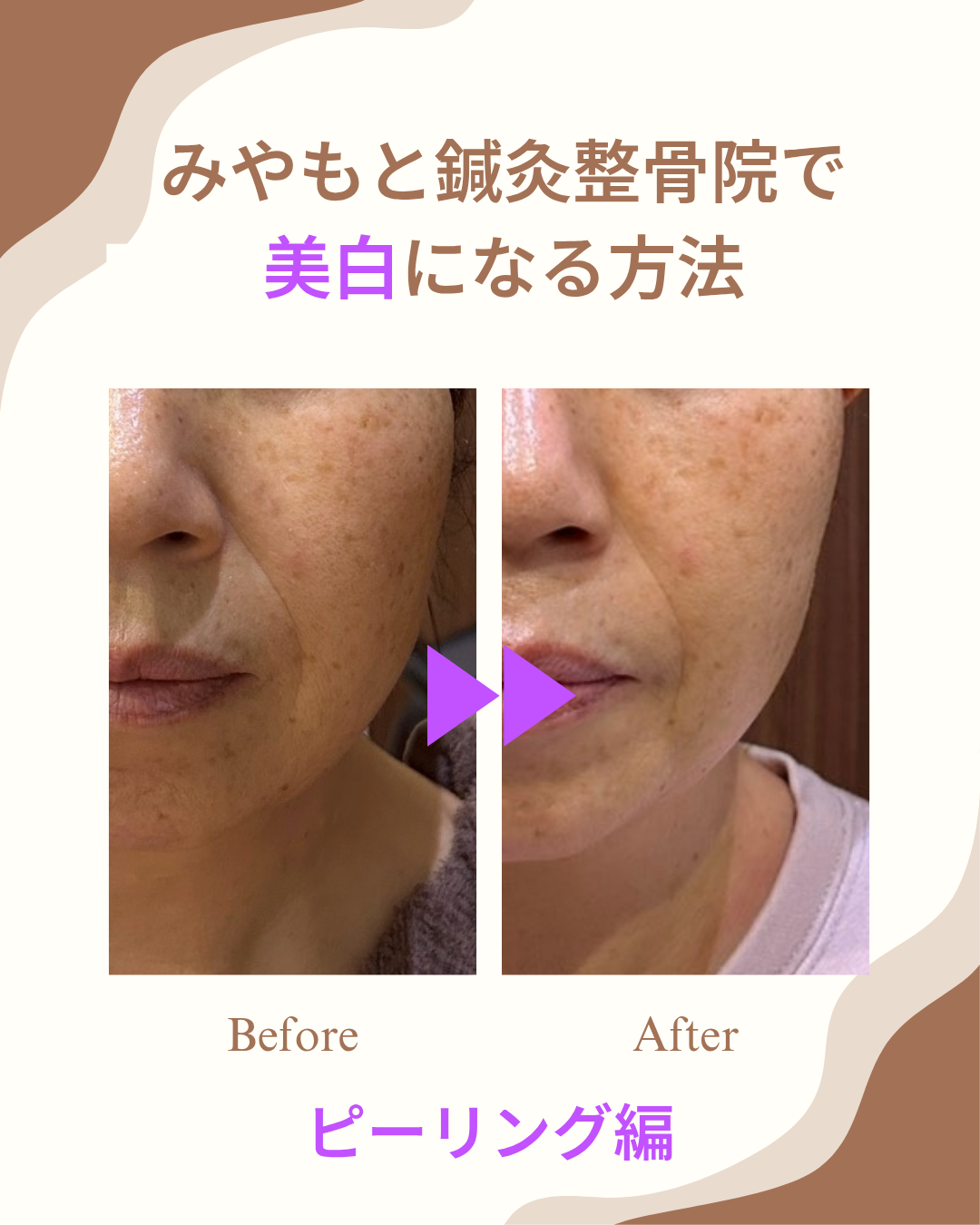 みやもと鍼灸整骨院で美白になる方法。ピーリング編
