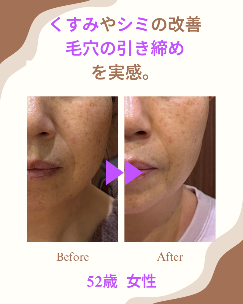 くすみやシミの改善、毛穴の引き締めを実感。52歳、女性。